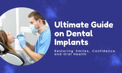 Ultimate Guide on Dental Implants: Restoring Smiles, Confidence, and Oral Health