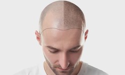 A Comprehensive Guide to Hair Transplant Treatment  Introduction: