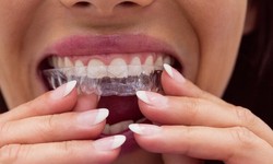 Invisalign in Dubai: Transform Your Smile with New Ivory Dental Clinic