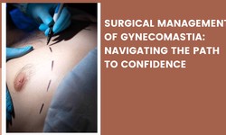 Surgical Management of Gynecomastia: Navigating the Path to Confidence