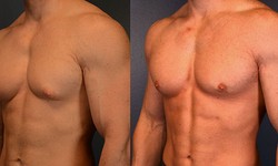 Gynecomastia in Your 40s- What to Know