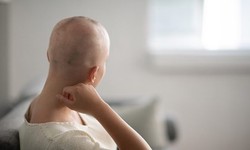 Lifestyle Impact of Hair Transplant Treatment