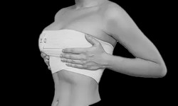 Why Choose Delhi for Breast Reduction Surgery? (The Aesculpir (Centre for Cosmetic and Plastic Surgery)
