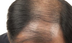 Hair Transplant Treatment for Women: A Comprehensive Guide