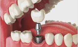 Dubai's Leading Dental Implant Innovations