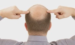 The Impact of Weather and Climate on Hair Transplant Recovery