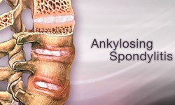 Living with Ankylosing Spondylitis: Embracing the Warrior Within