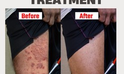 Scalp psoriasis homeopathy treatment without any side effect