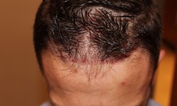 At what age is it appropriate to get a hair transplant?