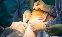 The Ultimate Guide to Ligament Reconstruction Surgery: What to Expect