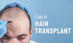 Who Is An Ideal Candidate For FUE Hair Transplant?