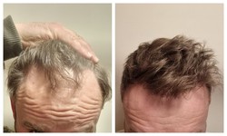 Are there any age restrictions for getting a hair transplant?