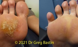 Unveiling Effective Solutions: Wart Removal Services in Melbourne