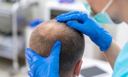 Unlocking Secrets of 2000 Grafts Hair Transplant Cost: Your Guide to Lowest Price Estimate