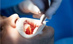 Wisdom Unveiled: A Comprehensive Guide to Wisdom Tooth Extraction in Markham