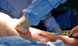 Liposuction and Body Contouring with Cutting-Edge Technology