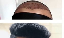 How Vitamin D Stopped My Hair Loss: Unveiling the Key Link