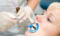 Guardians of Smiles: The Benefits of Dental Sealants in Lake Mary
