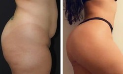 Cutting-Edge Liposuction Tech in Dubai: Beyond the Hype