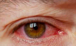Glaucoma: The “Silent Thief” of Sight and How to Outsmart It
