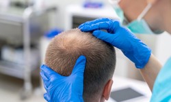 Revitalize Your Locks: Navigating Hair Transplants in Turkey
