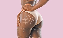 Brazilian Butt Lift: What Is It and How Long the Result Will Last