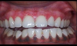 Understanding Dark Gums Through Oral Hygiene Causes