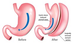 Factors That Influence the Success of Gastric Balloon Weight Loss Surgery