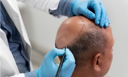 Unveiling Excellence: Discovering the Best Alopecia Treatment in London