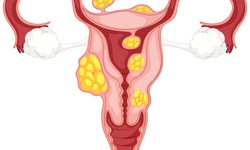 What Is Bulky Uterus? Causes, Symptoms, Treatment