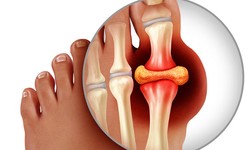 The End of Gout: A Complete Guide To Unique Way to Stop Gout Pain