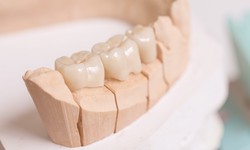 Top 9 Advantages Of Dental Bridges