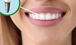 Revitalize Your Smile: A Comprehensive Guide to Dental Implant Treatment