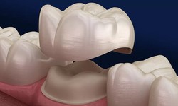 Dental Crowns: The Art of Restoring Smiles and Health