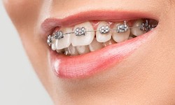 Achieve a Perfect Smile with Braces in Dubai: Your Complete Treatment Guide