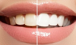 Achieving Long-Term Results with Teeth Whitening in Abu Dhabi