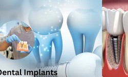 Elevating Oral Wellness: A Comprehensive Guide to Dental Implants in Gurgaon