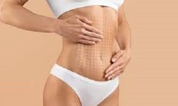 Mini Tummy Tuck Cost: Finding Quality at an Affordable Price in Abu Dhabi