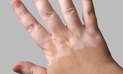 From Down Under to Upbeat: Vitiligo Cure Breakthrough in Australia