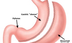 Navigating Weight Loss Options: Is Gastric Sleeve Surgery the Right Choice for You?