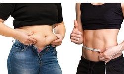 Role of Gastric Banding in the Fight Against Obesity