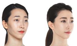 Demystifying Korean Face Surgery Recovery: A Patient-Centered Guide