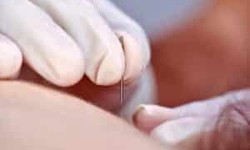 Exploring Relief: How Does Dry Needling Therapy at Family Physiotherapy in Edmonton Make a Difference?