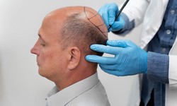 Turkish Tresses: A Complete Guide to Hair Transplants in Turkey