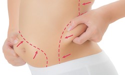 Embrace Your Beauty with Liposuction in Abu Dhabi