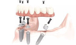How Much Will Dental Implants San Diego Cost In 2024?
