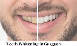 Say Goodbye to Stained Teeth: Dr. Ishant Singhal's Guide to Effective Teeth Whitening