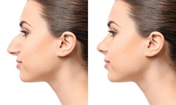 Broad Nose Correction With Rhinoplasty