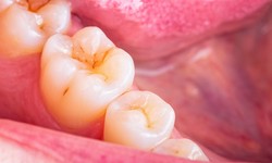 Decoding Dental Health: What Do Cavities Look Like?
