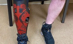 Bionic India: Revolutionizing Mobility with Advanced Prosthetics